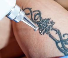 Check out PiQo4 laser for tattoo removal in action PiQo4 is the gold  standard when it comes to tattoo removal We are able to achieve great  clearance  By Wilmington Dermatology Center 